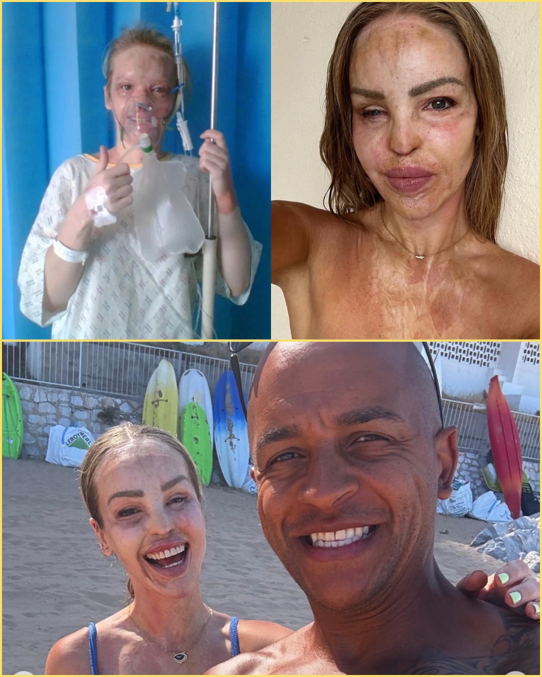 Survivor, Warrior, Icon — Katie Piper Stuns the World in Blue Bikini 17 Years After Ac-id Attack, Proving Pain Never Won