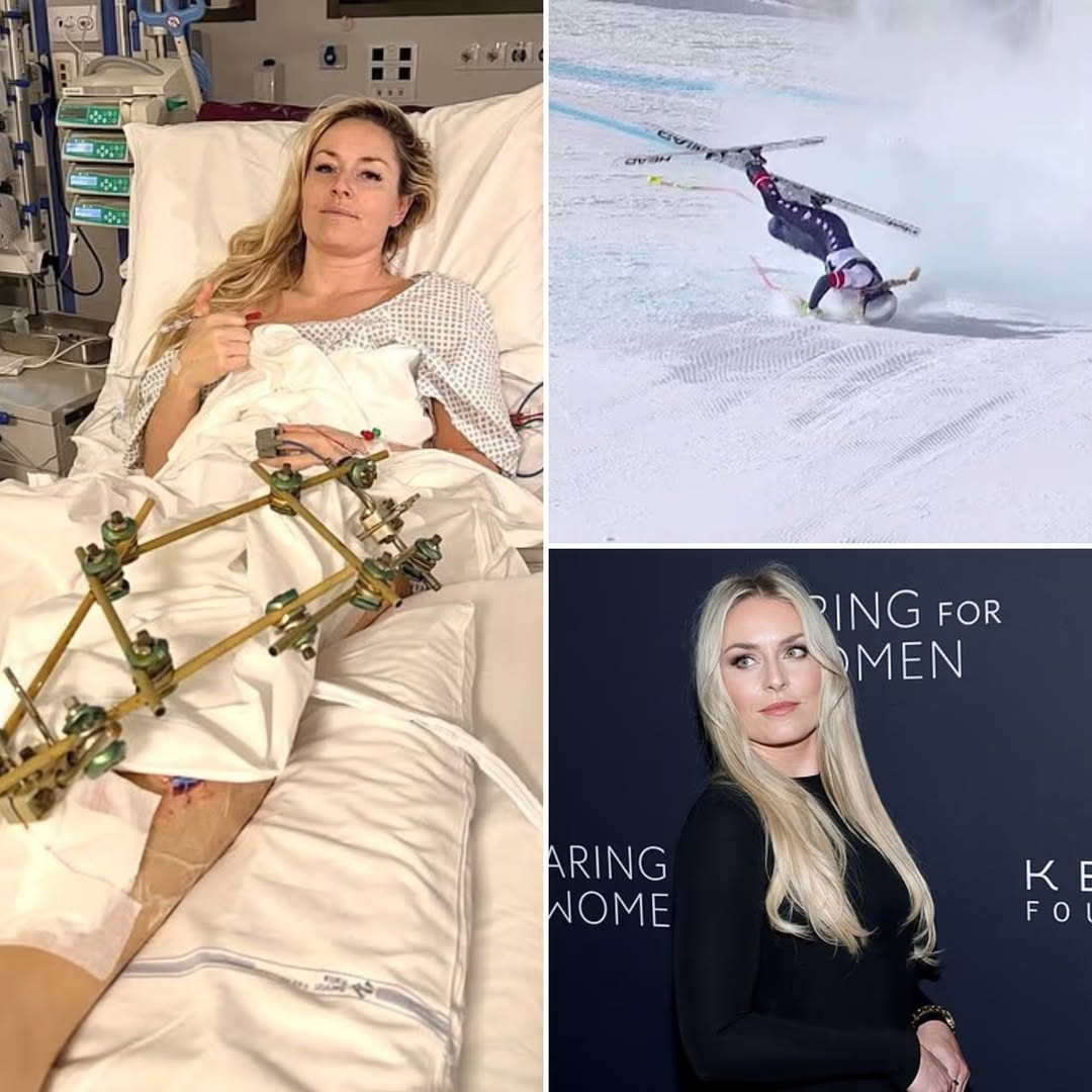 SHE ALMOST LOST BOTH LEGS. ❄️ The Hidden Medical Emergency After Lindsey Vonn’s Crash  It wasn’t just a fall. It was a race against time.
